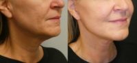 55yo woman treated with neck lift/jawline tightening