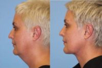 45-54 year old woman treated with Neck Lift
