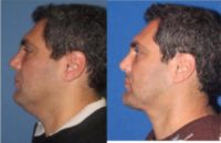 45-54 year old man treated with Neck Lift