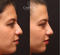 25-34 year old woman treated with Injectable Fillers for non-surgical nose job