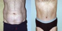 45-54 year old man treated with Male Tummy Tuck