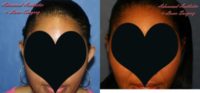 45-54 year old woman treated with Incisionless Otoplasty