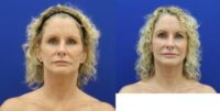 55-64 year old woman treated with Facial Fat Transfer