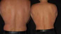 47 year old woman treated with CoolSculpting