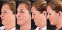 45-54 year old woman treated with Mini Facelift