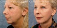 SMAS facelift/necklift; upper and lower blepharoplasty, chin implant