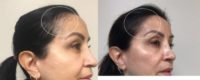 55-64 year old woman treated with Hair Transplant, FUE Hair Transplant