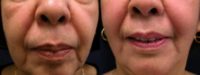 65-74 year old woman treated with Cheek Lift
