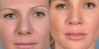 25-34 year old patient treated with Rhinoplasty