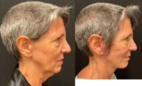 55-64 year old woman treated with Facelift, Neck Lift, MACS Facelift