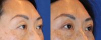 45 year-old female under upper eyelid surgery (blepharoplasty).