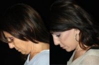 55-64 year old woman treated with Facelift, Neck Lift