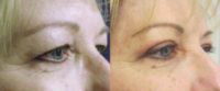 This patient is a 50 year old woman who underwent an upper blepharoplasty. These photos show her results at 8 weeks.