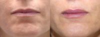 40 Year Old Female with Juvederm for Lips
