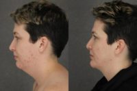 35-44 year old woman treated with Platysmaplasty and Chin Implant