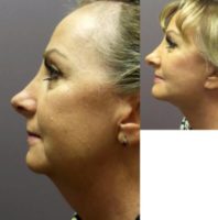 45-54 year old woman treated with Lower Face Lift & Chin Implant