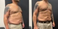 45-54 year old man treated with Ozempic for Weight Loss