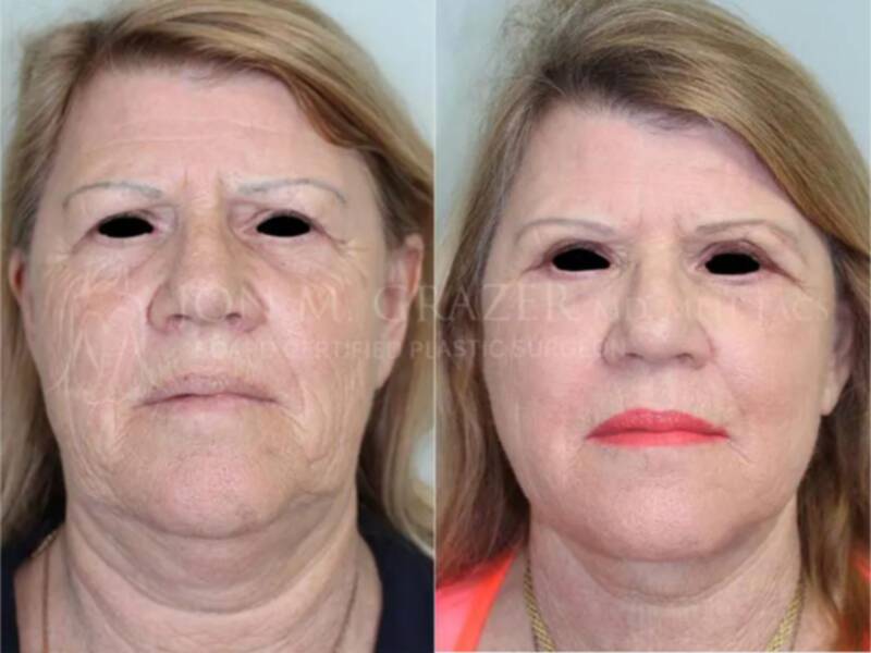 55-64 year old woman treated with Facelift, Eyelid Surgery, Facial Fat Transfer