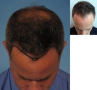 41 year old man gets NeoGraft Hair Restoration/Hair Transplant