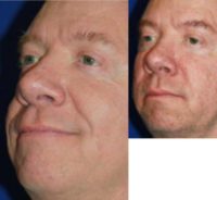 53 year old man treated with Cheek Augmentation