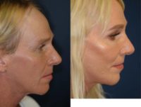 35-44 year old woman treated with Facial Feminization Surgery