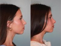 18-24 year old woman treated with Open Rhinoplasty