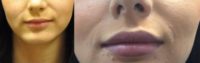 20 year old woman treated with Lip Augmentation