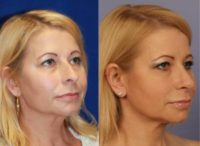 47 year old woman treated with Rhinoplasty