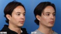 Man treated with Dermal Fillers