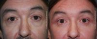 58 year old man treated with Eyelid Surgery
