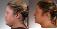 Woman treated with Chin Liposuction