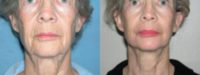 65-74 year old woman treated with Skin Rejuvenation
