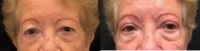 78 year old woman treated with Eyelid Surgery
