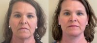 55-64 year old woman treated with Deep Plane Facelift