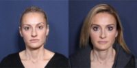 35-44 year old woman treated with Rhinoplasty (View 1 of 2)