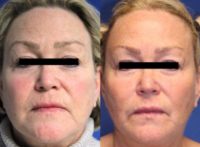 Facial Fat Grafting to the Nasolabial Fold, Marionette, Lips, Temple, and Pre-auricular areas