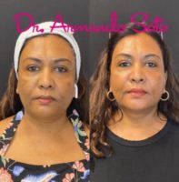 Woman treated with Skin Rejuvenation