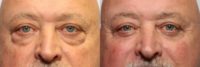 Man treated with lower Eyelid Surgery