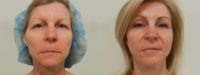 Woman treated with Brow Lift