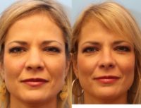 Rhinoplasty for wide nose
