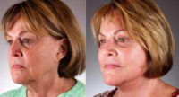 Soft, Natural Rejuvenation of the Face