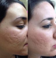 Woman treated with SkinPen
