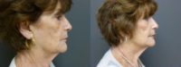 Ultherapy 71 yr. old female
