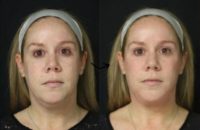 Woman treated with Voluma, Vollure