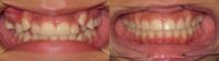 17 or under year old woman treated with Braces (SureSmile)