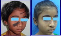 17 or under year old woman treated with Birthmark Removal