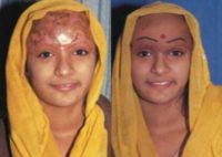17 or under year old woman treated with Scar Removal