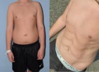 18-24 year old man treated with Liposuction and abdominal etching