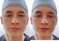 18-24 year old man treated with Volbella Lip Filler