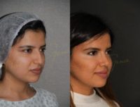 18-24 year old woman treated with Rhinoplasty